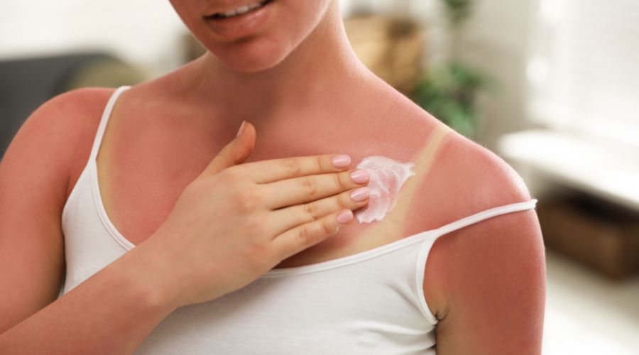 Auringon polttama iho vs. aurinkoihottuma – Mikä ero niillä on?