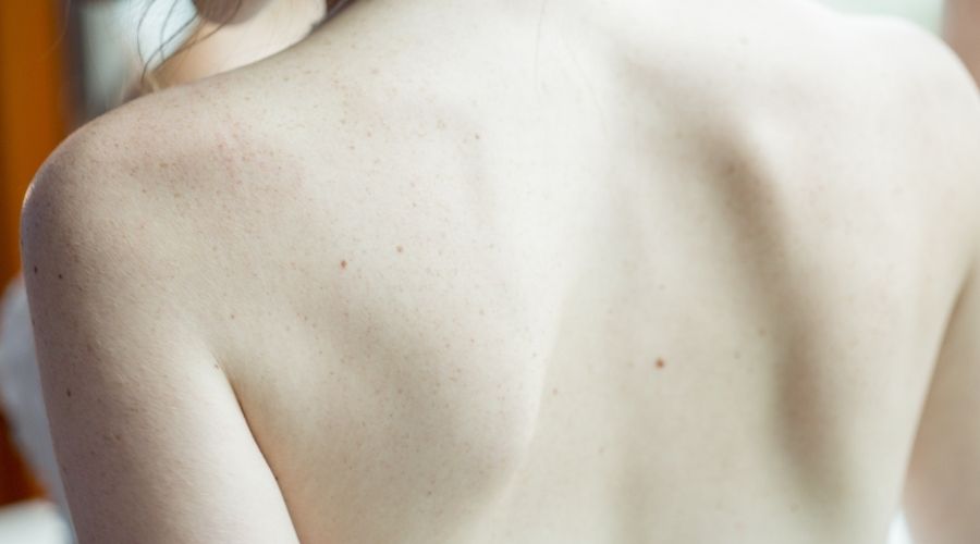 Psoriasis