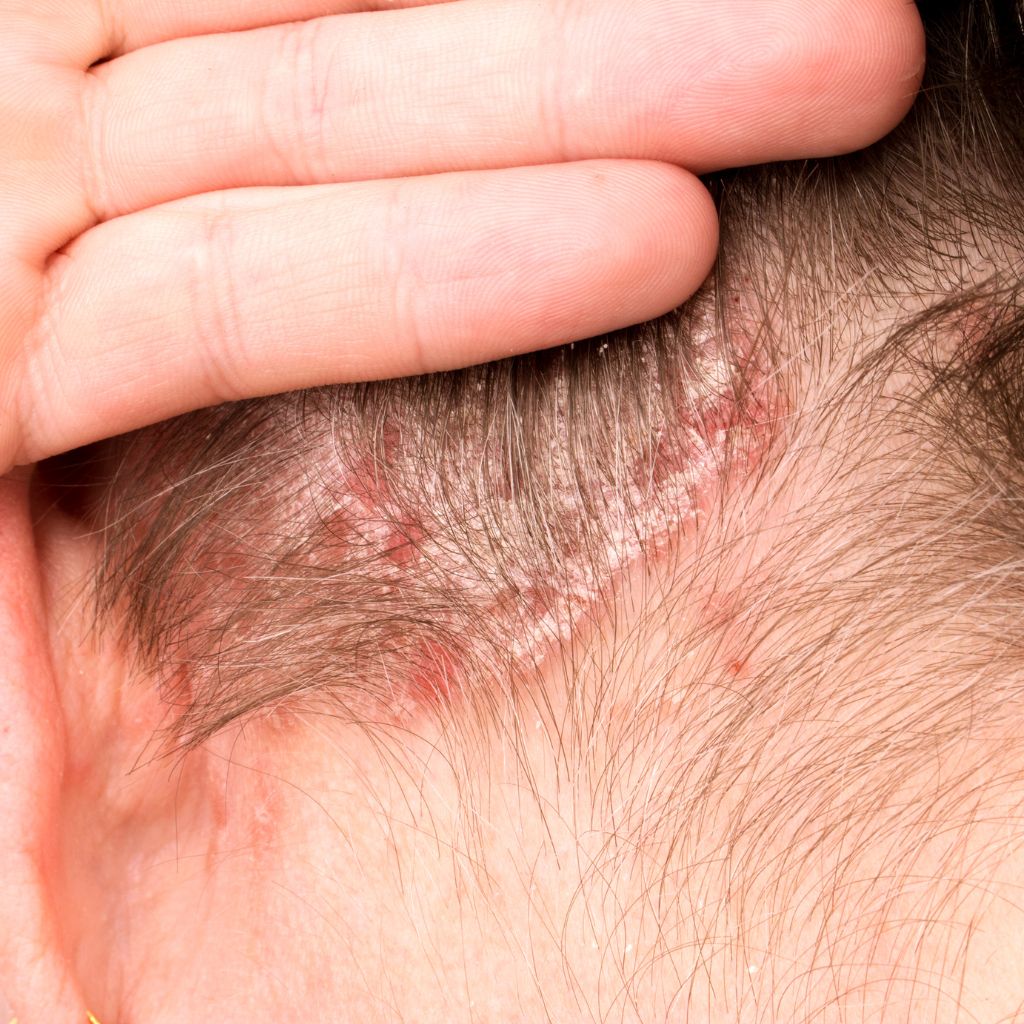 Psoriasis ihonhoitosetti