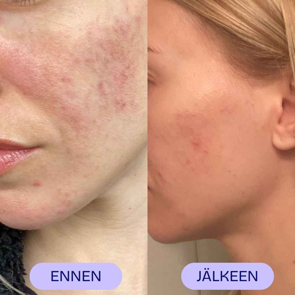 AYU Organics Tea Tree & Willow kasvoöljyn käytön ennen ja jälkeen asiakaskuva