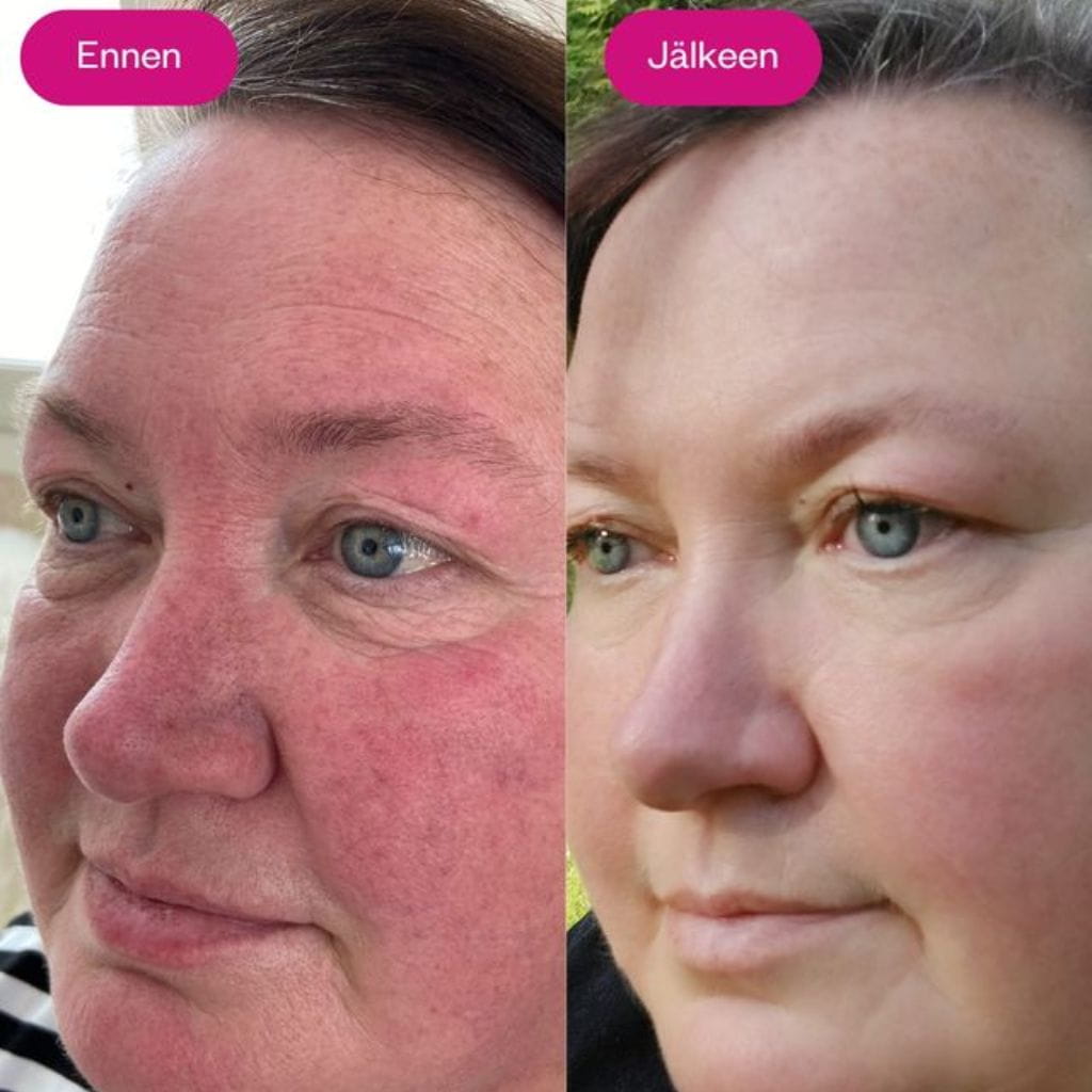 Bio retinolivoide Flow Cosmetics Retin Lift 3-in-1 Cream ennen ja jälkeen käytön