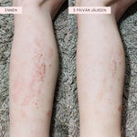 Flow Cosmetics Propolis & Probiotics Rescue Cream hoitovoide ennen ja jälkeen kuvat jalassa