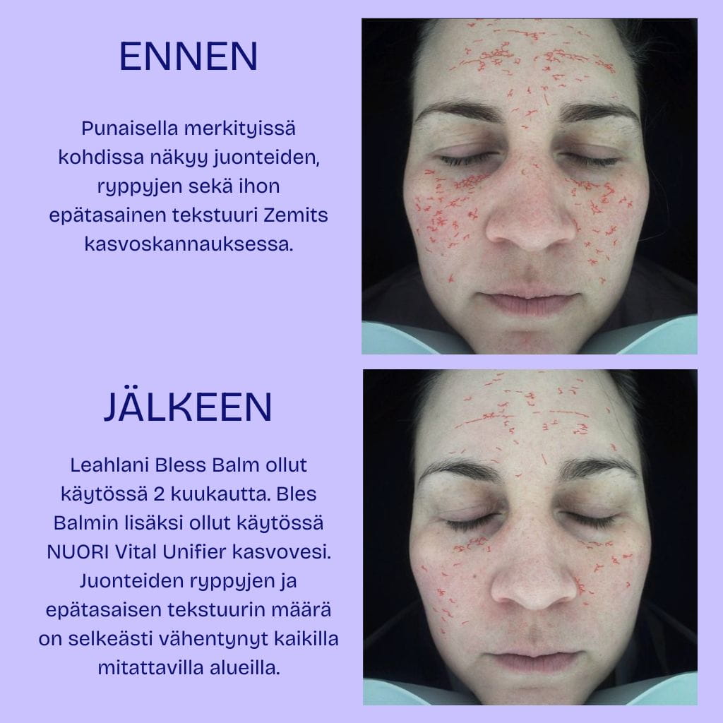 Leahlani Bless Balm ja NUORI VItal Unifier käyttö ennen ja jälkeen kuvat