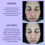 Leahlani Bless Balm ja NUORI VItal Unifier käyttö ennen ja jälkeen kuvat