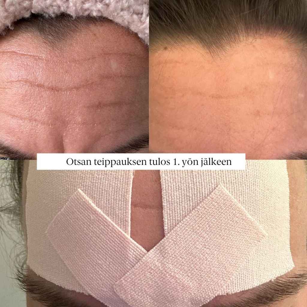 Otsa kinesioteippaus kokemuksia ennen ja jälkeen kuvat