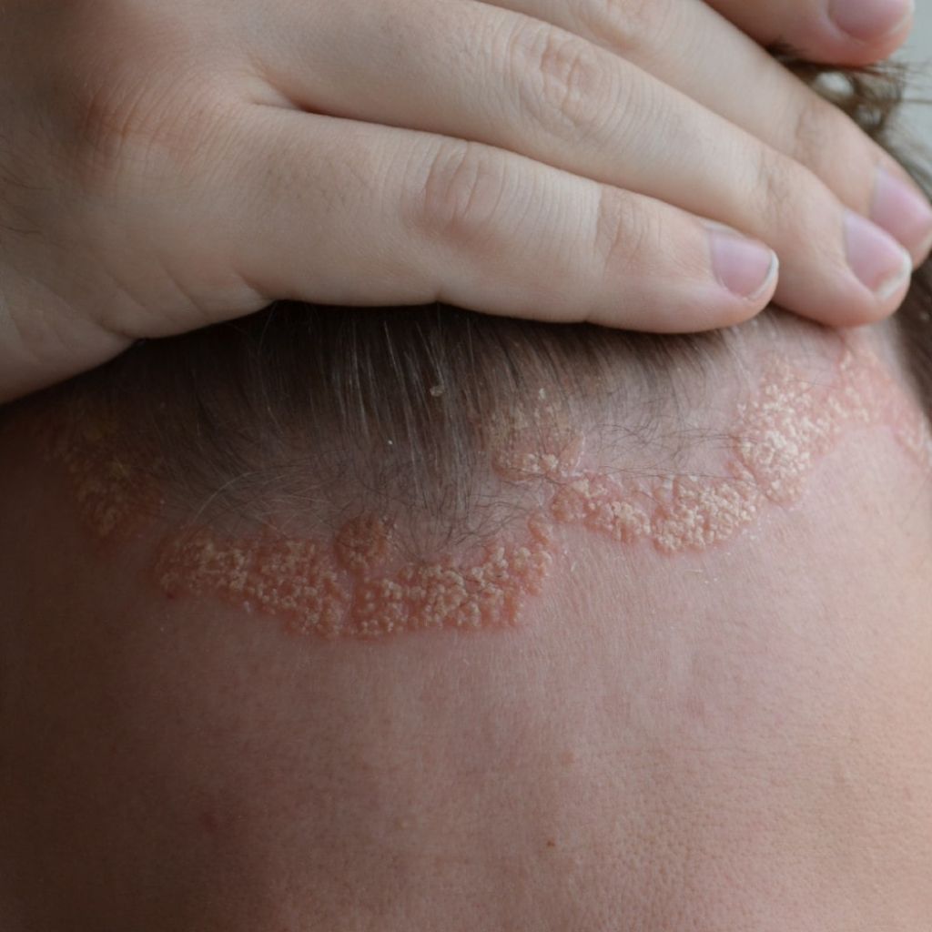 Psoriasis - asiantuntijan tuotesuositukset ja ohjeet hoitoon