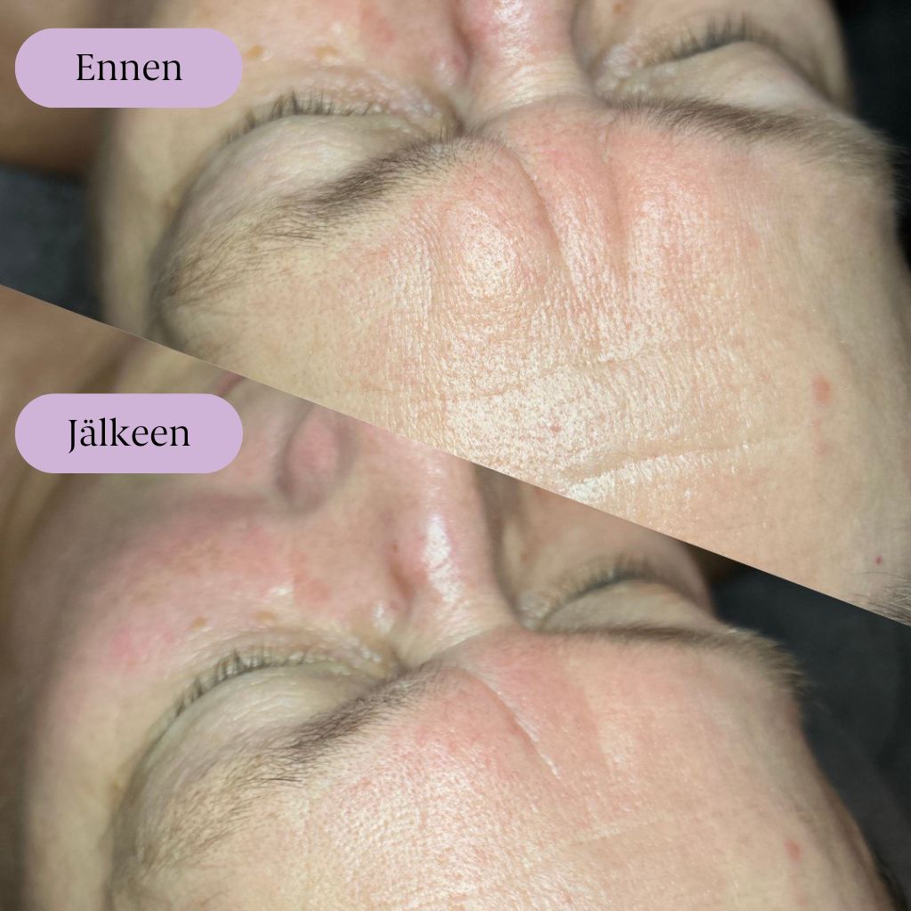 Yin Your Skin® Pro Gua Sha kasvohoito ennen ja jälkeen hoidon